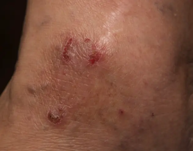 Patient with irritated skin and eczema patches before OPZELURA treatment