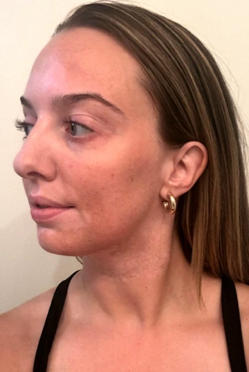 A young woman's face with vitiligo, showing more repigmentation progress at 2 years of treatment.