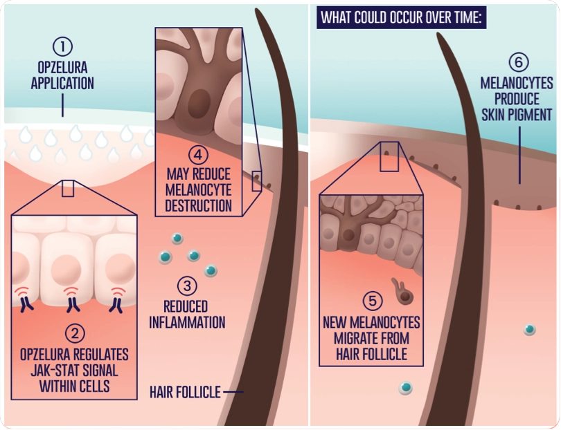 OPZELURA is applied and regulates JAK-stat signal within cells, which reduces inflammation and may reduce melanocyte destruction. Over time new melanocytes may migrate from a hair follicle and produce skin pigment