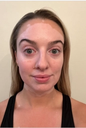 A young woman's face with vitiligo, showing more repigmentation progress at 2 years of treatment.